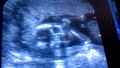 File:18 Week Ultrasound.webm