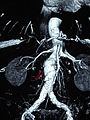 Abdominal aortic aneurysm.JPG